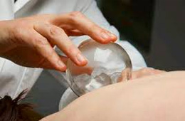 An experienced acupuncturist applies a cupping treatment to a patient.