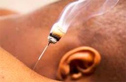 a Moxibustion treatment being applied by an experienced acupunturist.