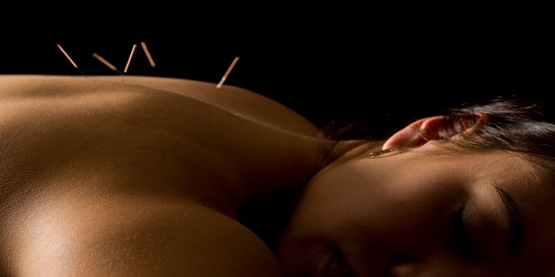 Relaxed women having acupuncture
