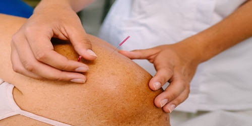 Acupuncturist inserting needle in womans shoulder