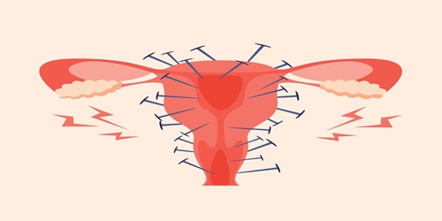 Vector of the uterus and ovaries, showing nails stuck into them to reflect endometriosis pain