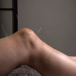 Acupuncture needles inserted into knee for pain